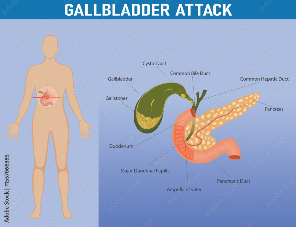 Gallbladder Path Vektor Medical illustration of gallbladder attack anatomy. Detailed ...