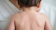 © Atelier d’Alya - Baby with skin rash showing symptoms of viral infection