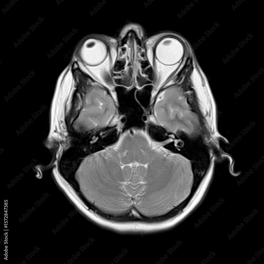Lower Temporal T2-weighted axial MRI scan of a 40-year-old patient showing cerebellum ...