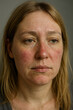 © Alessandro Grandini - Woman suffering from rosacea skin condition showing redness on face