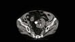© therads - A pelvic ectopic kidney with a renal stone , abdomen CT scan