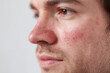 © Marut - Close up of man with rosacea flare on nose and cheeks showing red irritated skin and facial hair