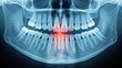 © Владимир Platon - Panoramic dental X-ray with a prominent red highlight on a specific tooth, visually indicating pain, infection, or a problematic area requiring immediate dental attention