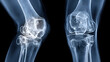 © john - Knee joint x-ray ap and lateral view, Early degenerative osteoarthritis , with white tonespng