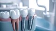 © ulf mine - 3d rendering jaw of dental implant