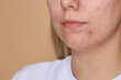 © New Africa - Woman with acne problem on beige background, closeup. Space for text