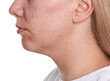 © New Africa - Woman with acne problem on white background, closeup