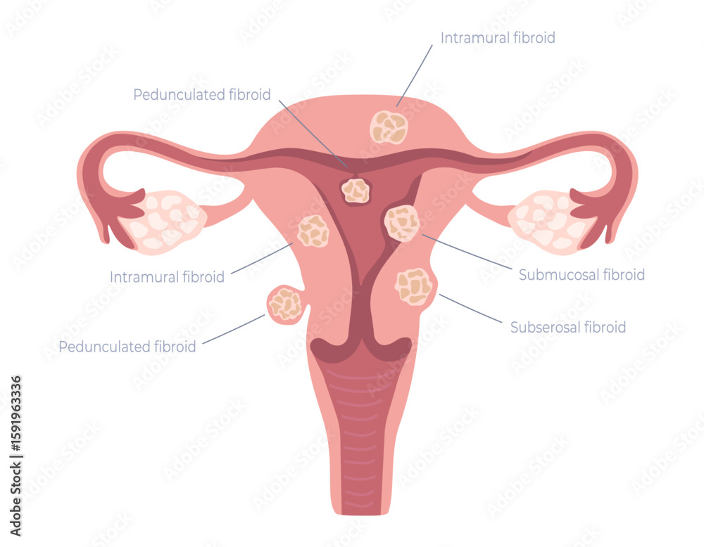 Female uterus with common types of uterine fibroids. Educational ...