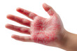 © SHORON - Close up of a hand with a red rash.