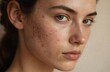 © Maryna - Close-up of young woman face with acne scars, blemishes. Focus on skin texture, imperfections, common skin problems like pimples, pores. Represents dermatology care, health, hygiene for troubled skin.