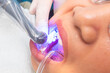 © Mdv Edwards - Final polymerization phase of dental composite using curing light on a lower premolar to harden the restoration material securely.