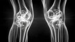 © Formoney - Two knee joints are shown in a black and white photo. The image is of a skeleton, and the knee joints are shown in a very detailed and realistic way. Concept of depth and realism