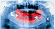 © elif - Panoramic dental x-ray of an old person with only two teeth and no tooth of the upper and lower jaw