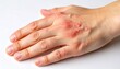 © AIUNIVERSE - Irritated red patches from eczema shown on a hand. Dry, flaky skin and cracked texture create a powerful visual of this chronic skin issue.