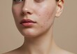 © lepiangg - Portrait of a Young Woman with Acne in a Minimalist Studio Setting