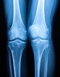 © Lena - An X-ray image of human knee joints, a concept for orthopedics and arthritis. Generated image