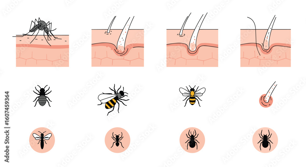 Understanding insect bites and stings how pests affect human skin and ...