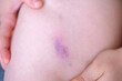 © kittyfly - little boy holds sore leg, human skin with large red and prominent purple bruise, showing discoloration from injury, Medical condition, childhood safety
