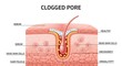 © Suwantono - Medical vector illustration showing the anatomy of a clogged pore compared to a healthy one, detailing sebum and dead skin cells buildup