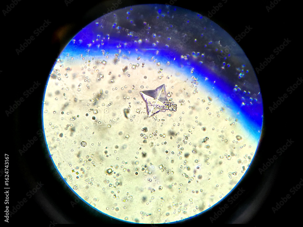Urine Microscopy Showing Calcium Oxalate Crystals in High Magnification ...