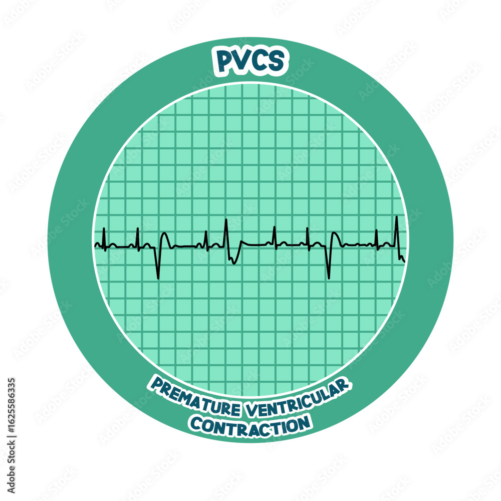 Premature ventricular contractions Stock Vector | Adobe Stock