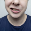 © Siniehina - Close-up of a young person showing facial asymmetry, characteristic of facial nerve palsy (Bell's palsy). Concept of neurological disorder, facial paralysis, or nerve inflammation.