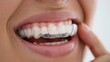 © uniyok - Close-up of smiling asian female with clear dental aligners on teeth