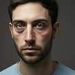 © ismail - Portrait of a man with facial injuries and bruises depicting domestic violence and physical abuse themes closeup studio shot
