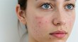 © Hendra - Dermatology close-up of young woman’s face with acne and red pimples on cheeks and chin, isolated on white background, skin condition photo