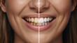 © GS-Studio - Comparison of teeth before and after whitening, showcasing a radiant smile
