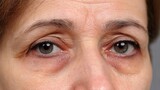 Swollen bags under circles and irritation concept. Close-up of a person's eyes showing signs of fatigue and aging.
