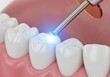 © ALAUDDIN - 3d illustration of dental procedure showing a tooth being filled with composite resin and cured with a blue light for restoration