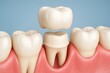 © Enigma - Dental professional carefully fitting ceramic prosthetic crown onto precisely prepared tooth surface, restoring dental structure with advanced restorative technique
