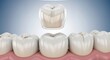 © Artem - Dental crown placement demonstrates restorative procedure in a patient's mouth with healthy gum tissue
