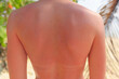 © 24K-Production - A person stands with sunburned skin on their back, showing visible redness. They are enjoying a sunny beach day surrounded by palm trees and sand during midday.