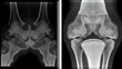 © John - Plain X ray reveals bilateral Avascular necrosis (AVN) of the femoral head more in the left side, a type of aseptic osteonecrosis, which is caused disruption of the blood supply to the proximal femur