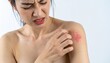 © LK - Woman Scratching Red Itchy Rash on Shoulder