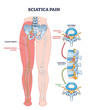 © VectorMine - Sciatica pain is shown with highlighted nerve, pain areas, and spine structure, illustrating causes and affected regions. Outline diagram