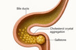 © RyujinxRyuken - Bile Ducts with Gallstone Formation, Medical Illustration [Illustration]