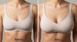 © galam - Before and after breast augmentation