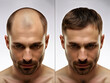 © JR Digital Art - The head of a balding man before and after hair transplant surgery. Hair loss treatment. Hair transplantation and extension. Hair growth products. Generative AI.