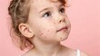 © Денис Никифоров - Child with Chickenpox Rash on Pink Background