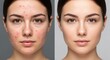 © ARI - Before and after showcasing acne treatment results on a young woman's face, highlighting clear skin transformation.