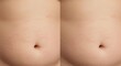 © themondunee - Closeup of a lightskinned abdomen with a navel and pink stretch marks
