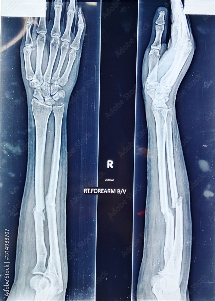 X-ray image of Right Forearm, shows fracture at the shaft of Radius And ...
