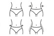 © Ciara - Weight loss line icon set. Body contouring, slimming concept. Woman waist before and after diet, liposuction. Female figure transformation. Fat removal plastic surgery vector.