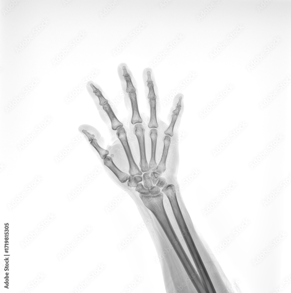 X Ray Rabbit Hand The image displays an X-ray of a human hand, which is a common ...