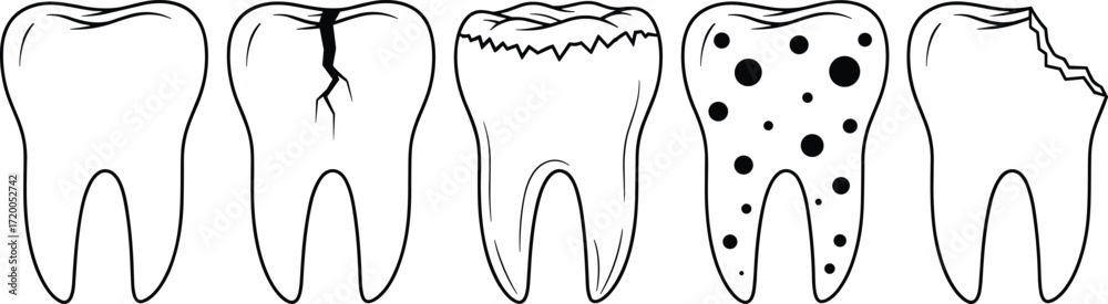 Illustration of the stages of tooth decay, showing the progression from ...
