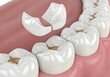 © Jignesh - Close up of teeth with a broken dental crown hovering above the damaged tooth in the gums view