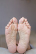 © Natallia - Human feet close view. The image reflects the concept of peeling skin and callus.
